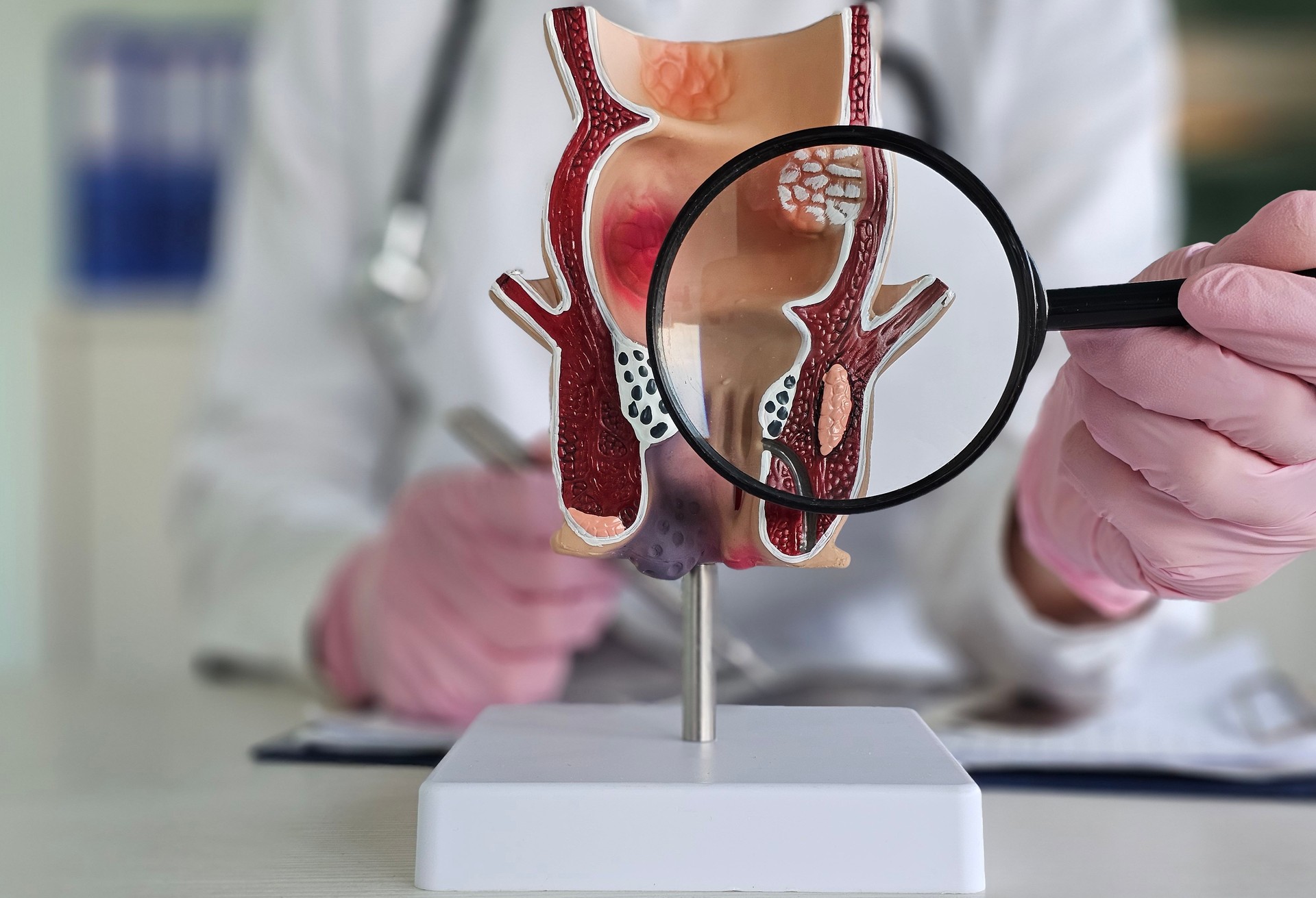 El proctólogo sostiene una lupa y un modelo anatómico del recto con hemorroides. Enfermedades del recto, signos y concepto de diagnóstico