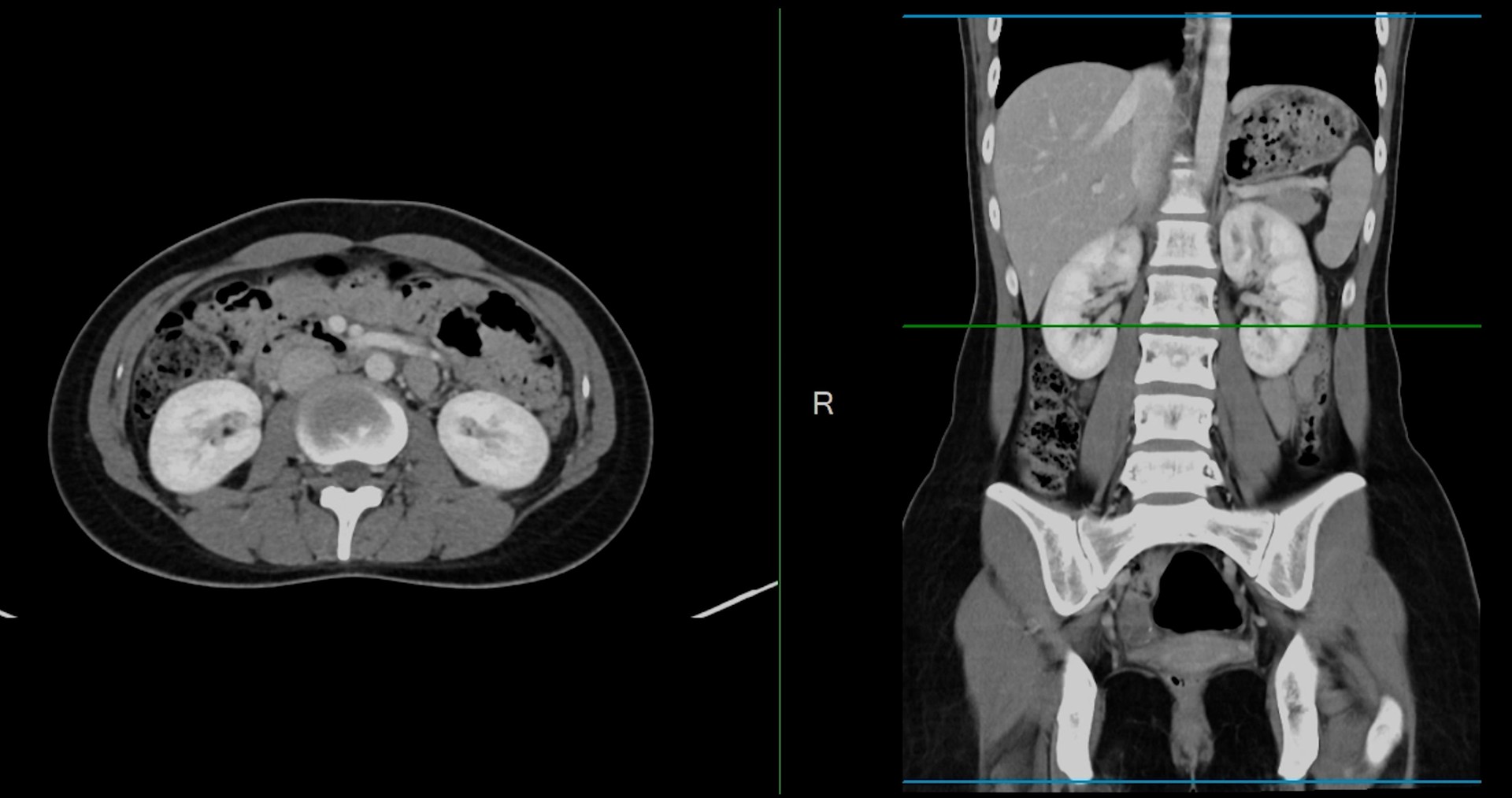 Contrast-enhanced CT whole abdomen study revealing normal anatomical structures, with no signs of pathology or abnormal fluid accumulation.