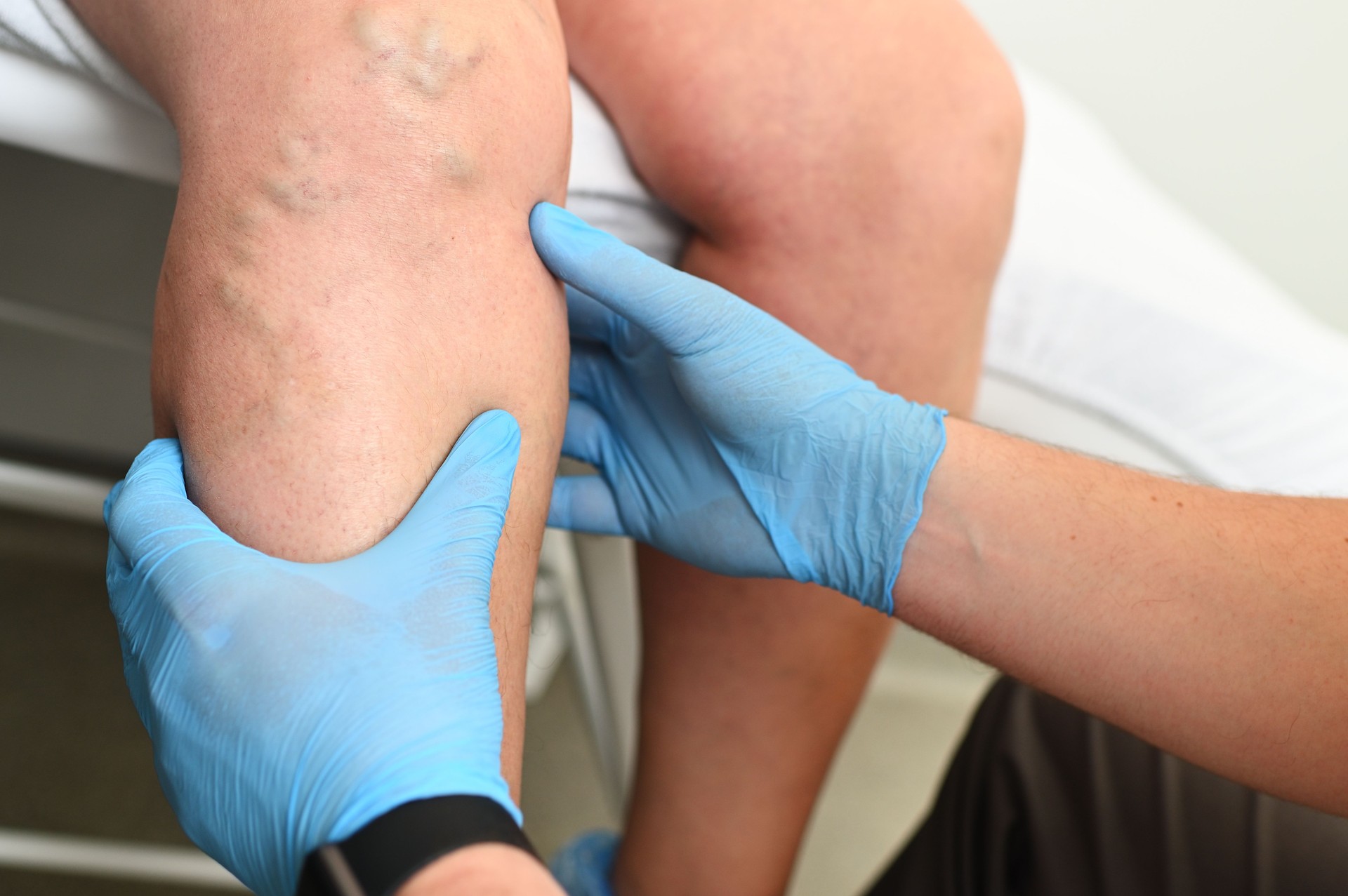 El hlebólogo examina a un paciente con venas varicosas en la pierna