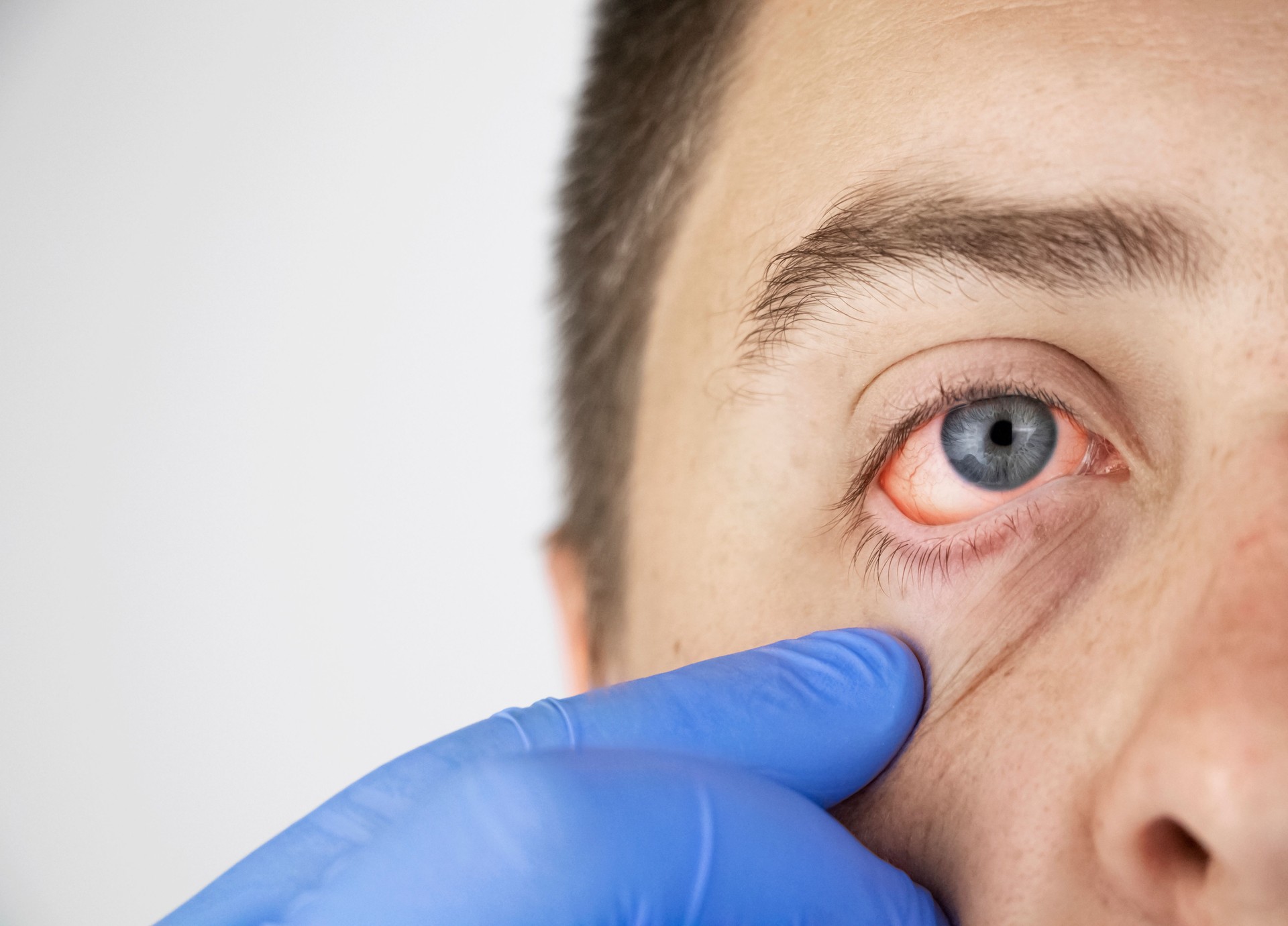 Primer plano de dos ojos de sangre roja molestos de varón afectado por conjuntivitis o después de la gripe, resfriado, alergia. Copiar espacio para publicidad. Ojos cansados después de trabajar en la computadora. Primer plano y macro