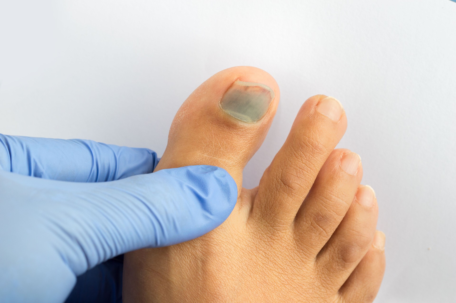 médico comprobando la uña del pie izquierdo que sufre de hematoma subungual azul