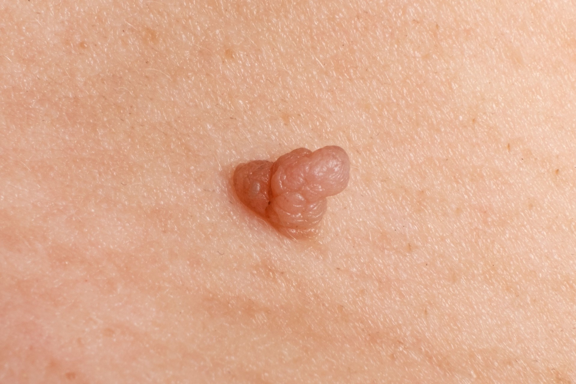 cáncer papiloma en la piel, verruga de cerca