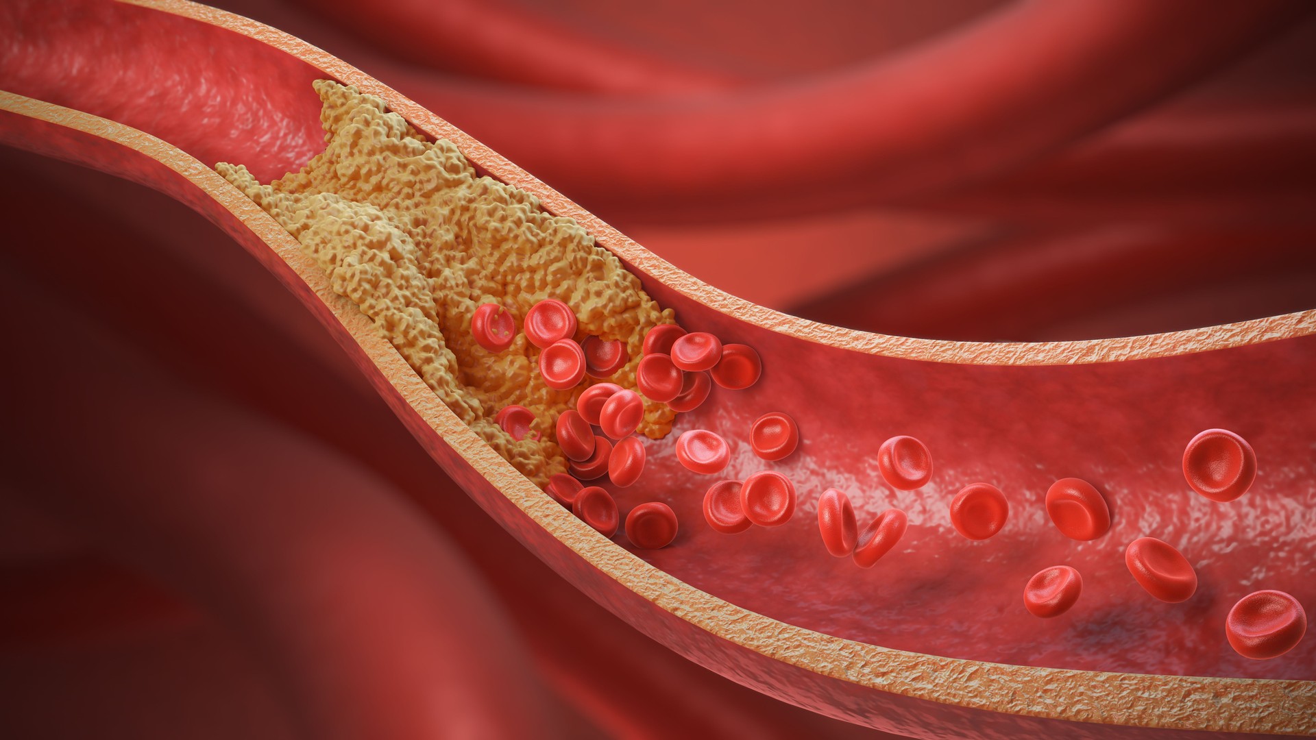 Colesterol alto en la sangre, arterias y venas engrosadas.