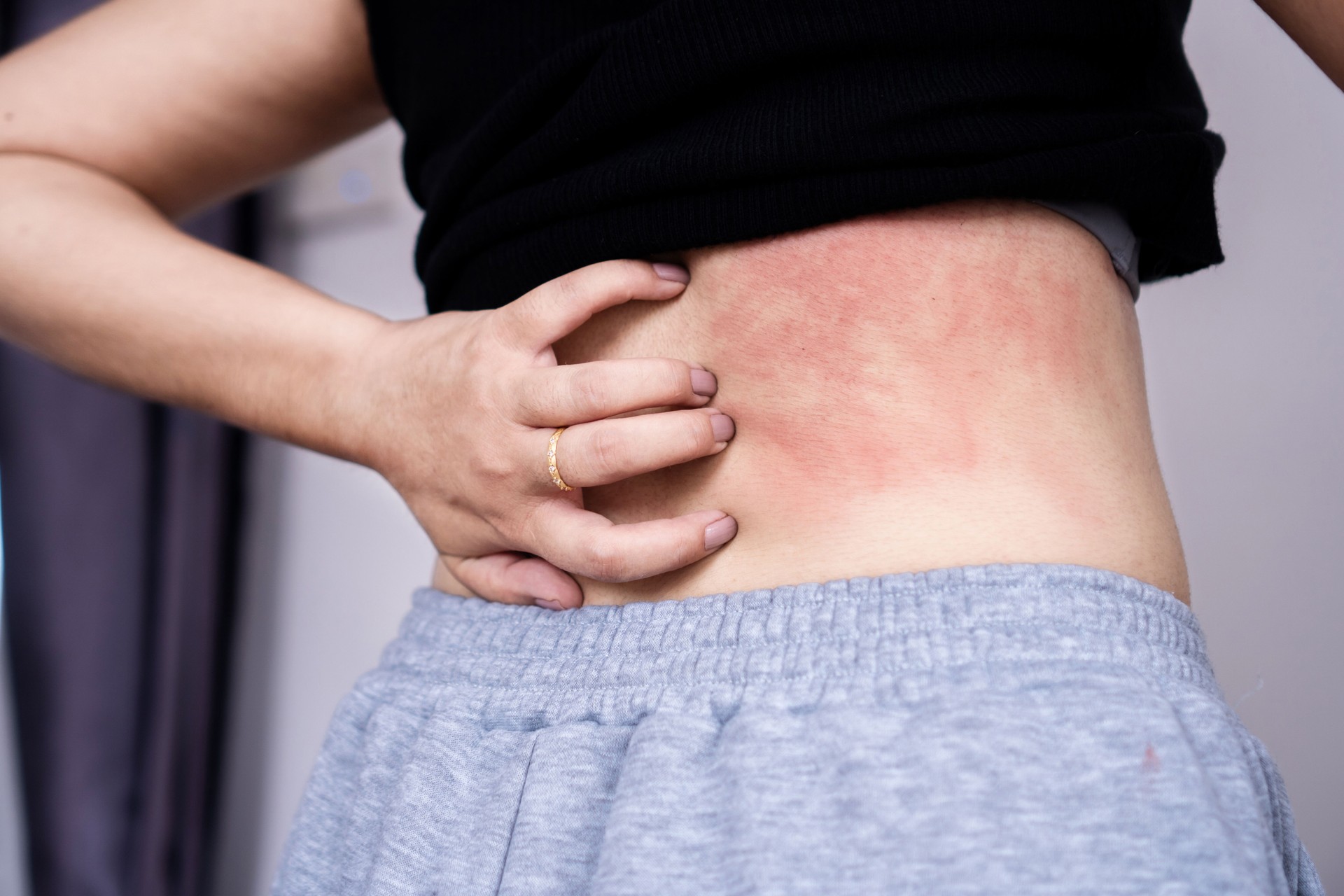 Mujer que sufre de enfermedad de la piel que se rasca la mano en la espalda con picazón debido a la alergia al sudor